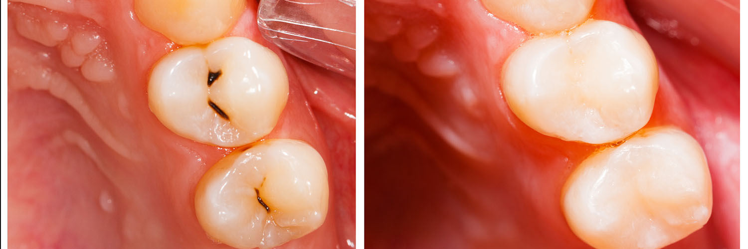 Jeansonne Spillers Dentistry
