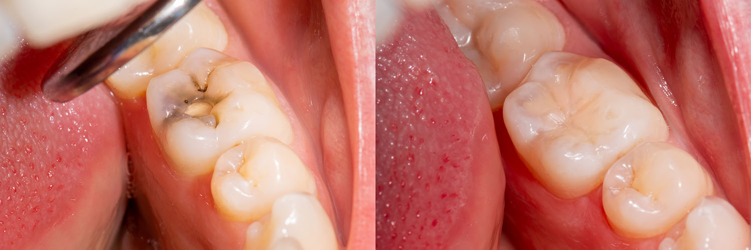 Jeansonne Spillers Dentistry