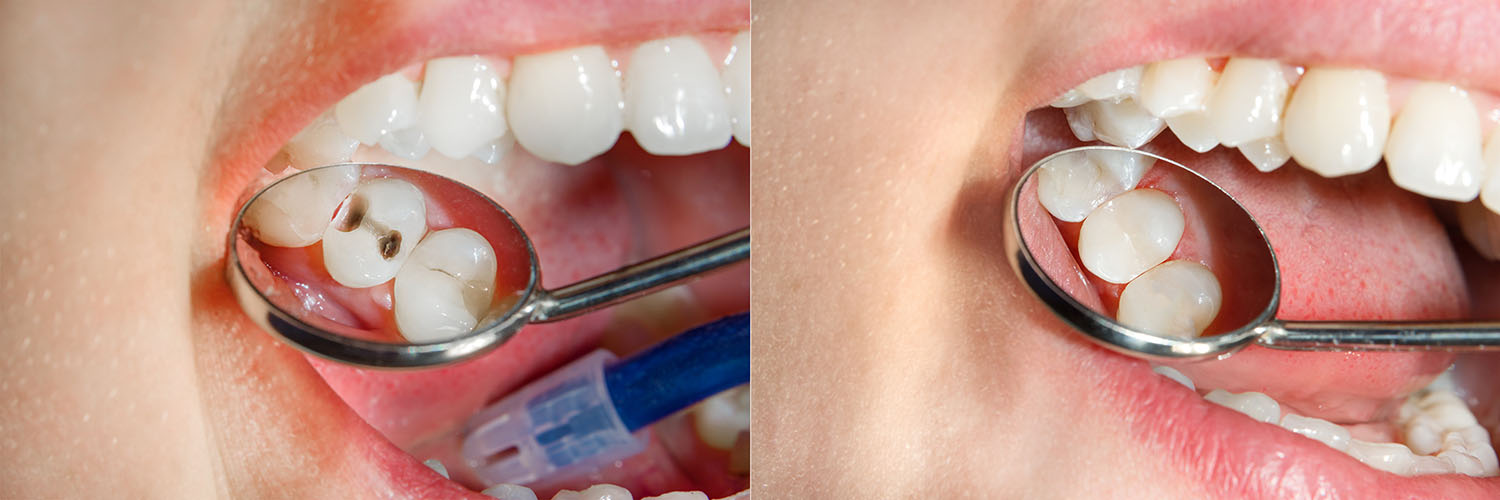 Jeansonne Spillers Dentistry